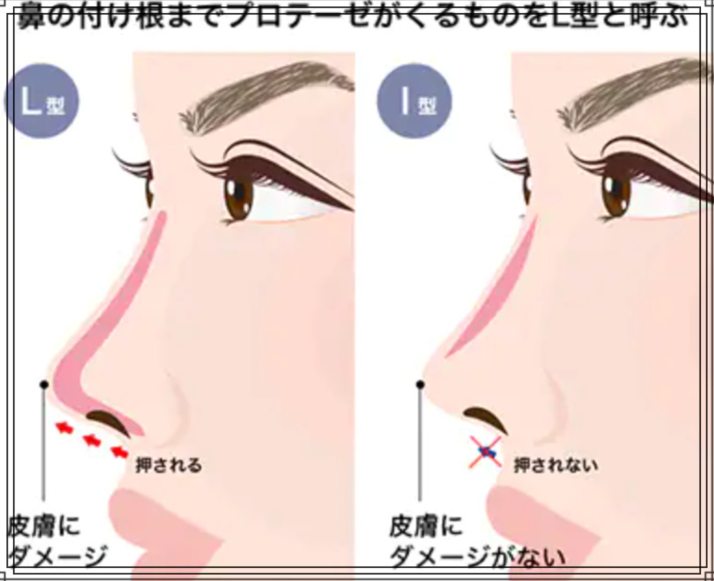 鼻プロテーゼのイメージ図